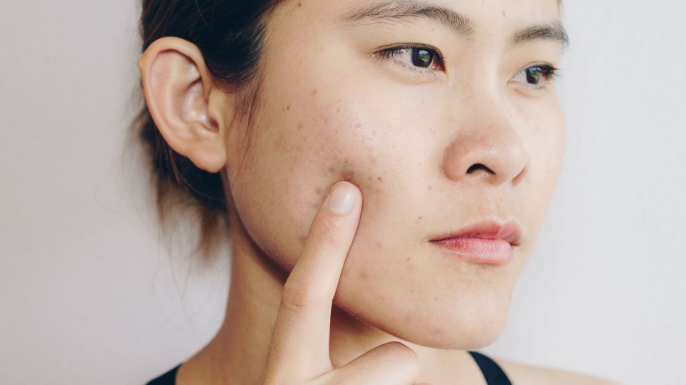 do-you-know-how-to-clear-your-acne